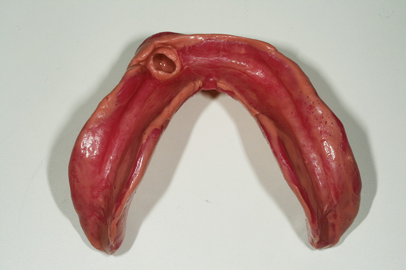 下顎義歯印象